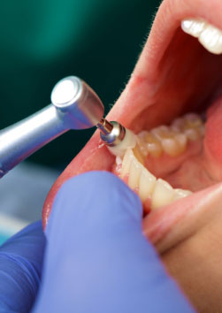 image of close up of a professional dental brushing at the clinic