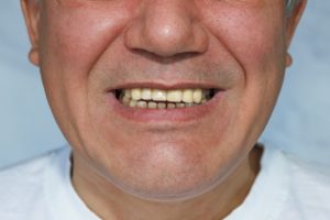 image of old man with false front upper teeth