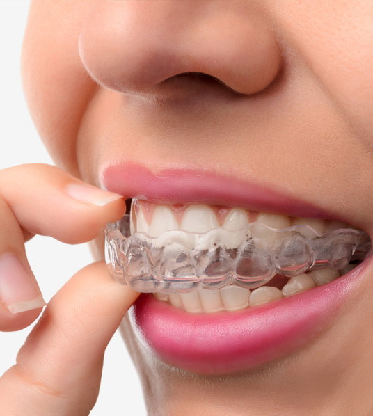 image of woman wearing orthodontic silicone trainer
