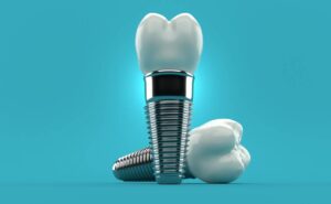 featured image for my dental implant fell out now what