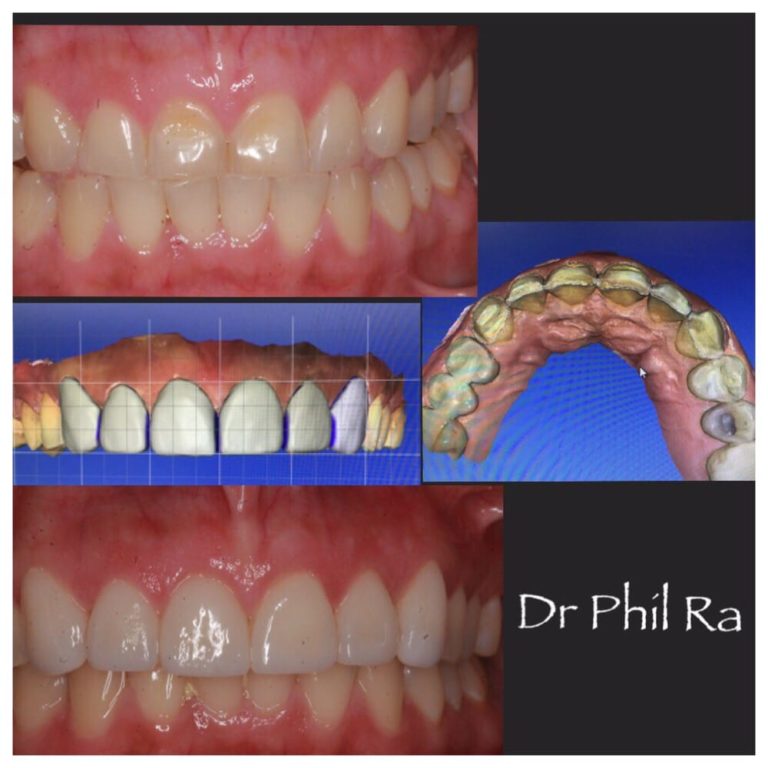 Patient 11 Before & After image