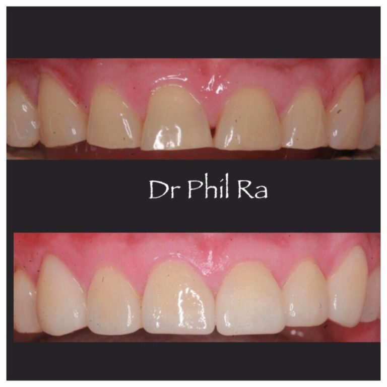 Patient 9 Before & After image