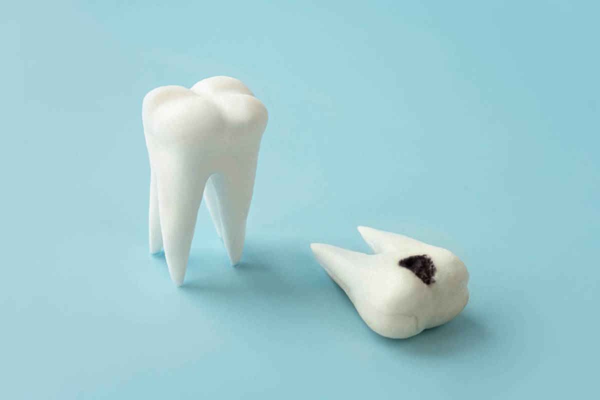 featured image for why do dental fillings fall out